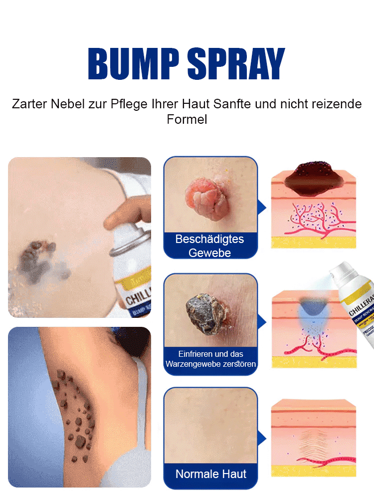 Frostspray – 96% Warzenwurzelentfernung, schmerzfrei & narbenfrei, Versand innerhalb Deutschlands.