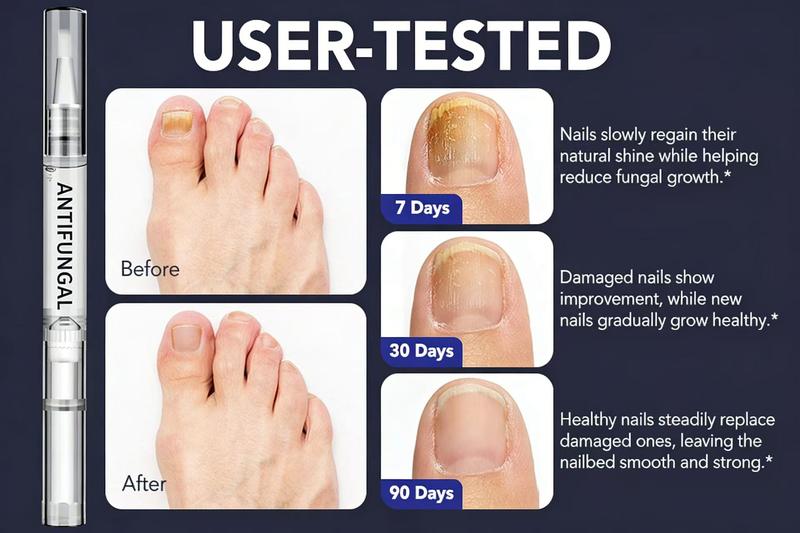 抗真菌护理笔 &ndash; 适用于受损指甲和足部真菌感染指甲，含25%十一烯酸和茶树油，强效趾甲真​​菌修复笔