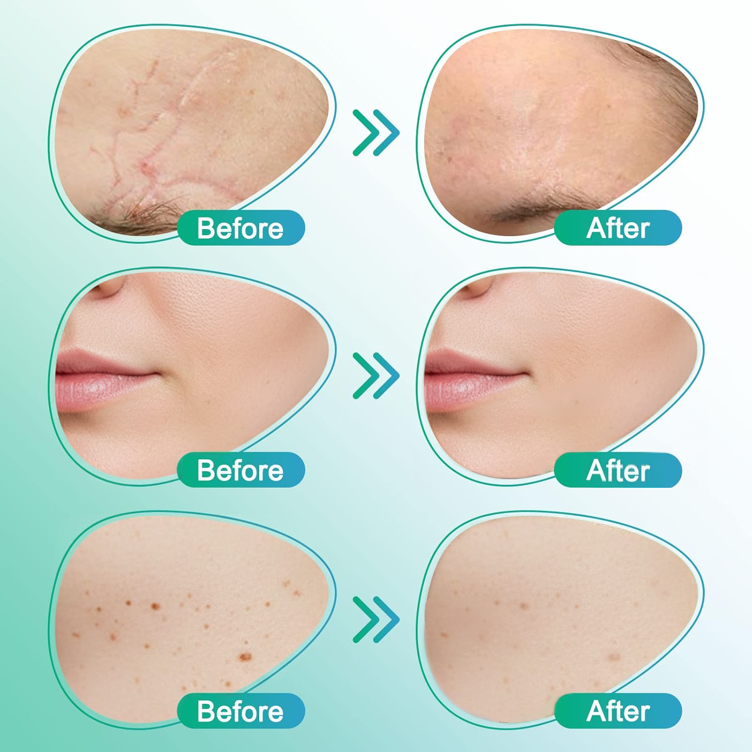 𝗖𝗮𝗿𝗲𝗕𝗿𝗲𝗲𝘇𝗲® 3-in-1 Microneedle Care Patch