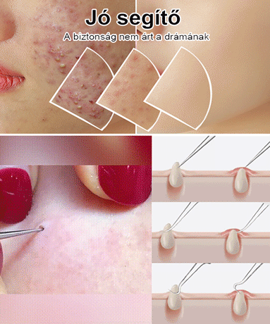 🔬Szuperpontosságú csipesz🧪Végleges blackhead eltávolító