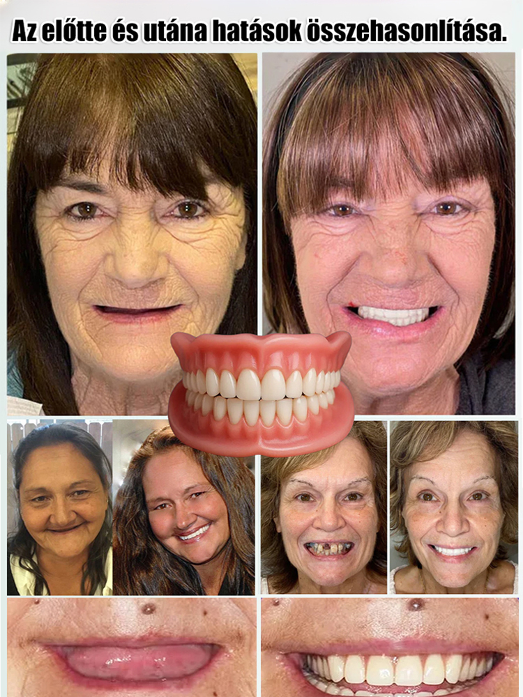 🔴Olyan kényelmes, mintha a saját fogaid lennének - sőt, még annál is jobban! 🔴