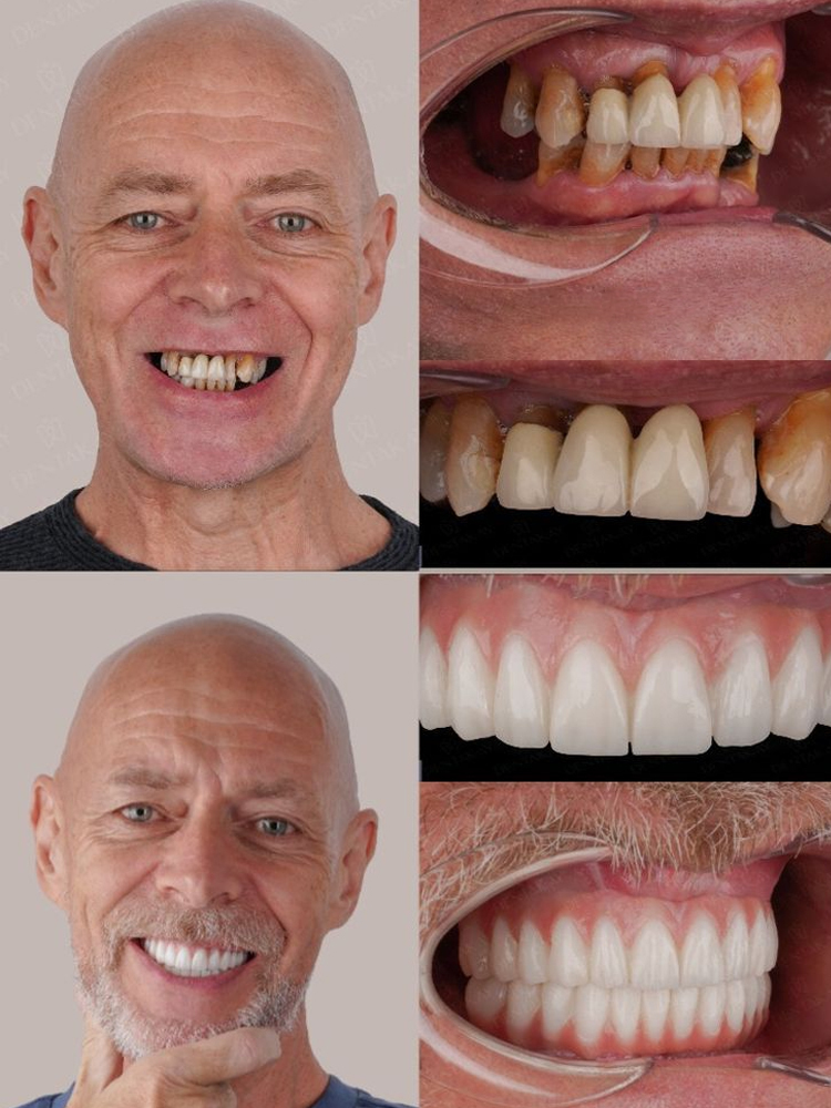 Két perc alatt visszanyered mosolyodat! 👦 Búcsú a drága fogorvosi díjaktól!