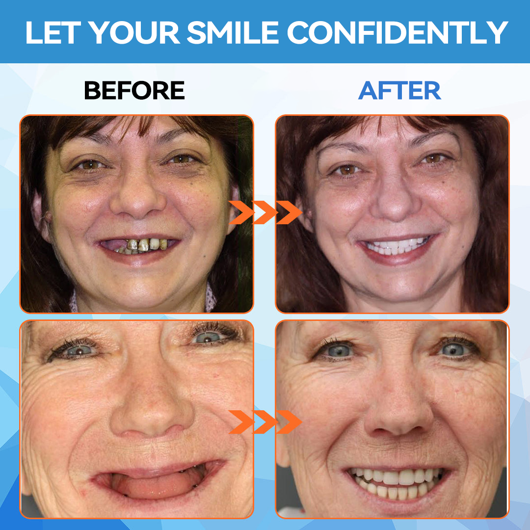 Minceetbien™🗽 Silicone Reline Denture Set (⏰Limited Time 80% Off - Last 30 Minutes ⏰)