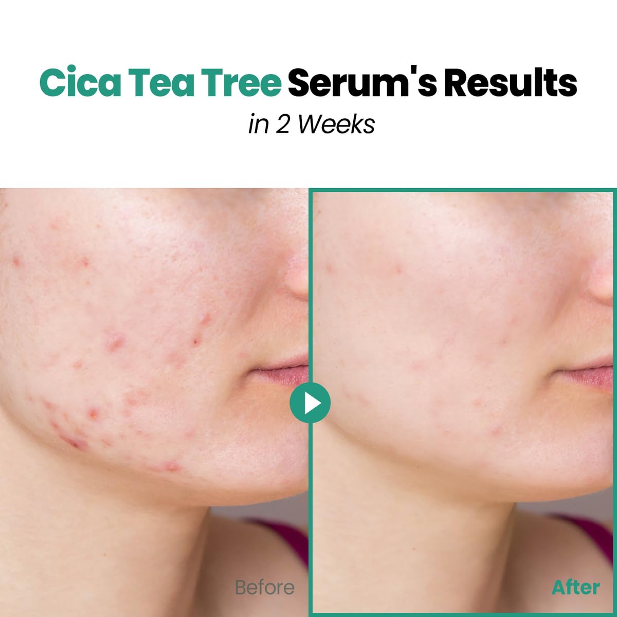 GLAM UP CICA Tea Tree serum Double Shot 30ml(1.12 Fl Oz)