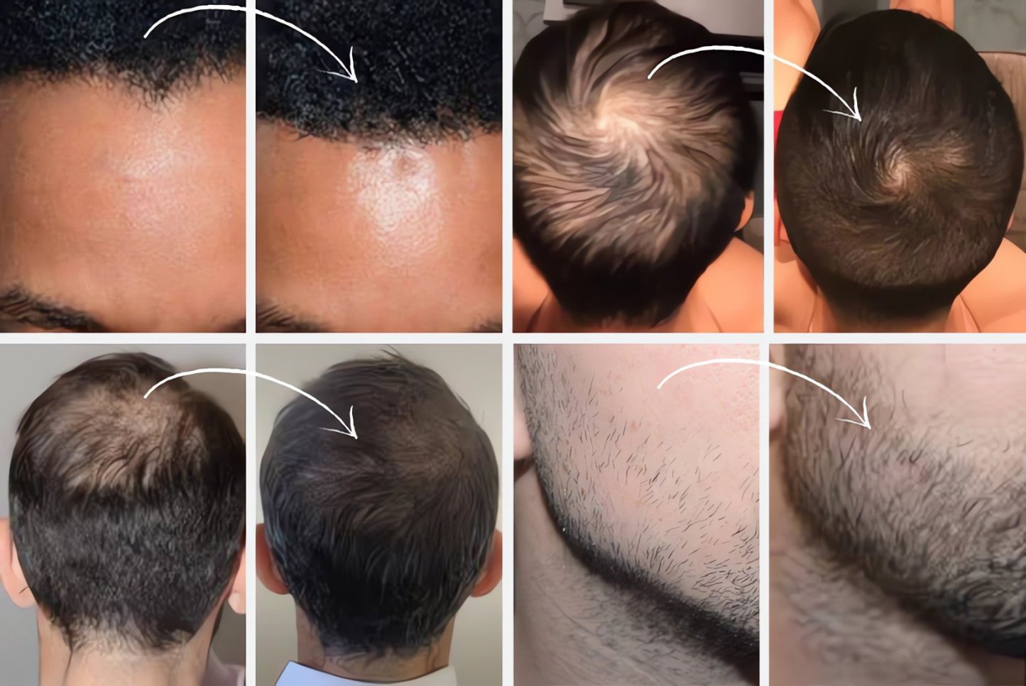 🔥Hairline Powder - Instant Coverage for Thinning or Balding Areas