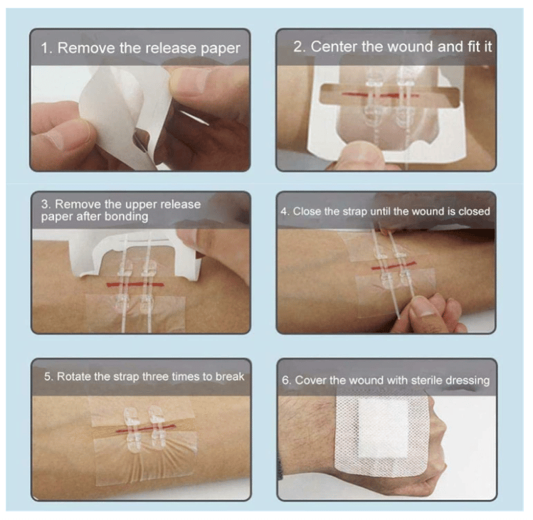 Laceration suturing kit, bandages, zipper butterfly bandages, wound care and first aid patches.