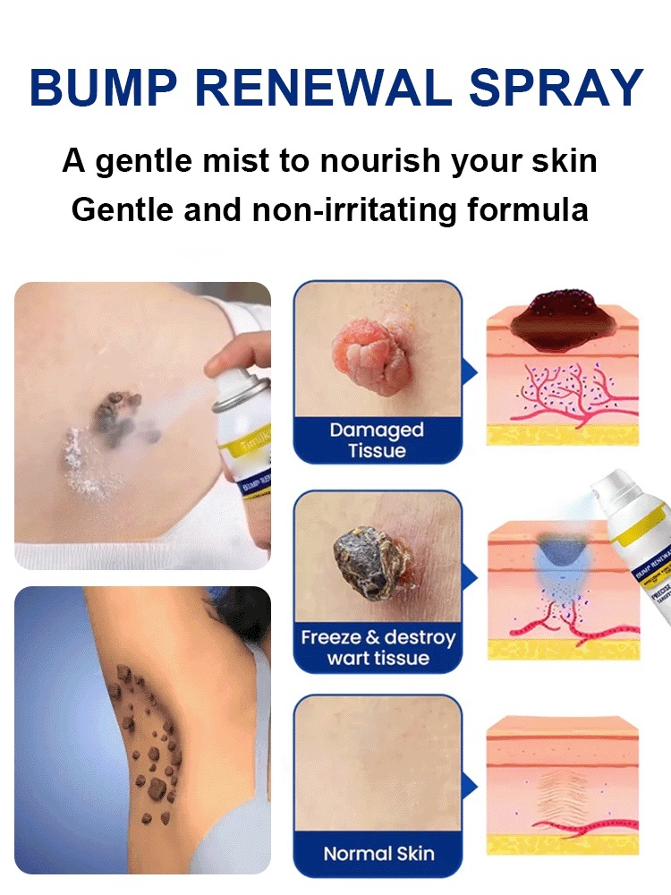 🚀 Painless Wart Spray: 7 Days to Clear Skin, No more embarrassing warts!