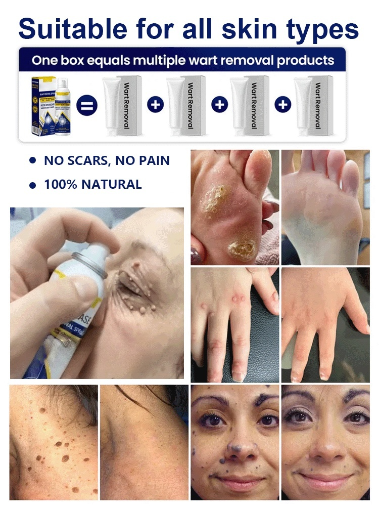 🚀 Painless Wart Spray: 7 Days to Clear Skin, No more embarrassing warts!