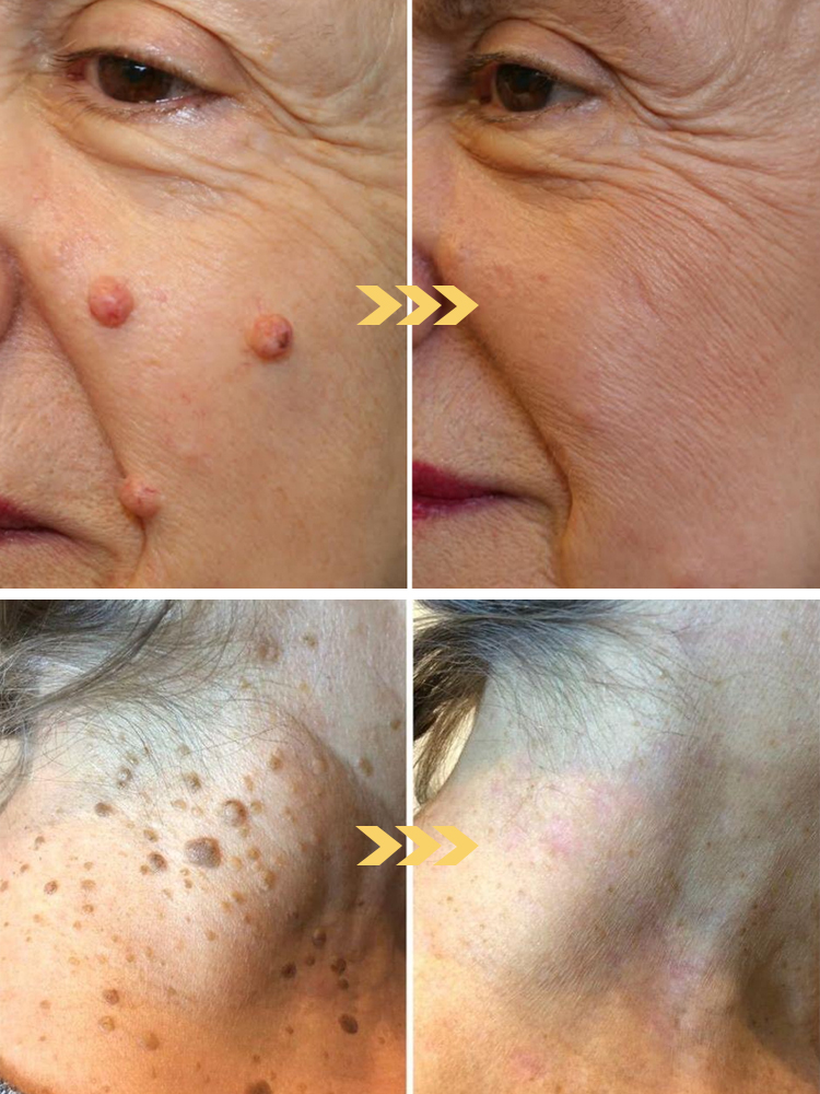 🚀 Painless Wart Spray: 7 Days to Clear Skin, No more embarrassing warts!