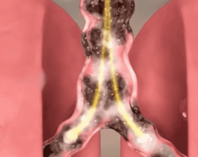 肺部动图啦啦啦啦啦222 (1).gif