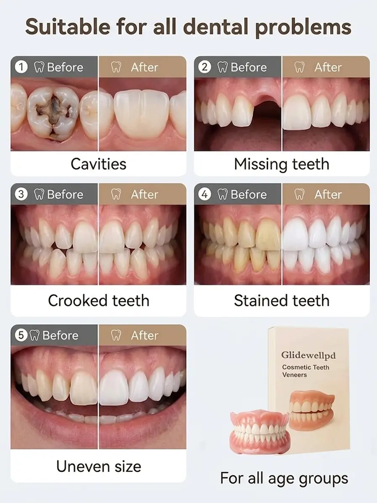 INSTANT FLAWLESS SMILE! 🇺🇸 Official US Recommended Cosmetic Veneers – FLASH SALE ENDS TONIGHT! ⚡