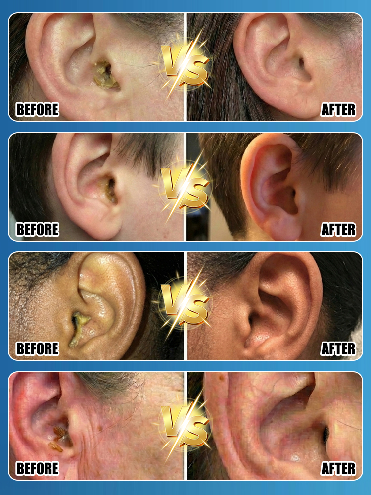 Premium 5-Hole Sonic Ear Wax Remover [Made in USA Designed / CE Certified] – Safe 30-Second Ear Irrigation System. STOP Using Dangerous Cotton Swabs Now!