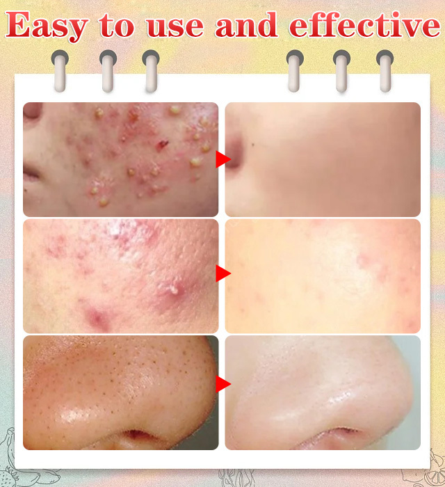 Zero-Blemish Aesthetics ✨High precision and high hardness cell clamp💎🧖‍♀️ Reshaping Pure Skin Texture