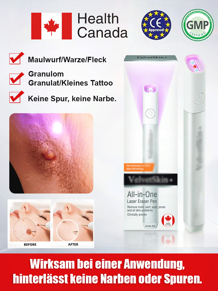 【Dauerhafte Entfernung】 Entfernung von Muttermalen, Warzen und Hautwucherungen, Laser-Muttermalentfe