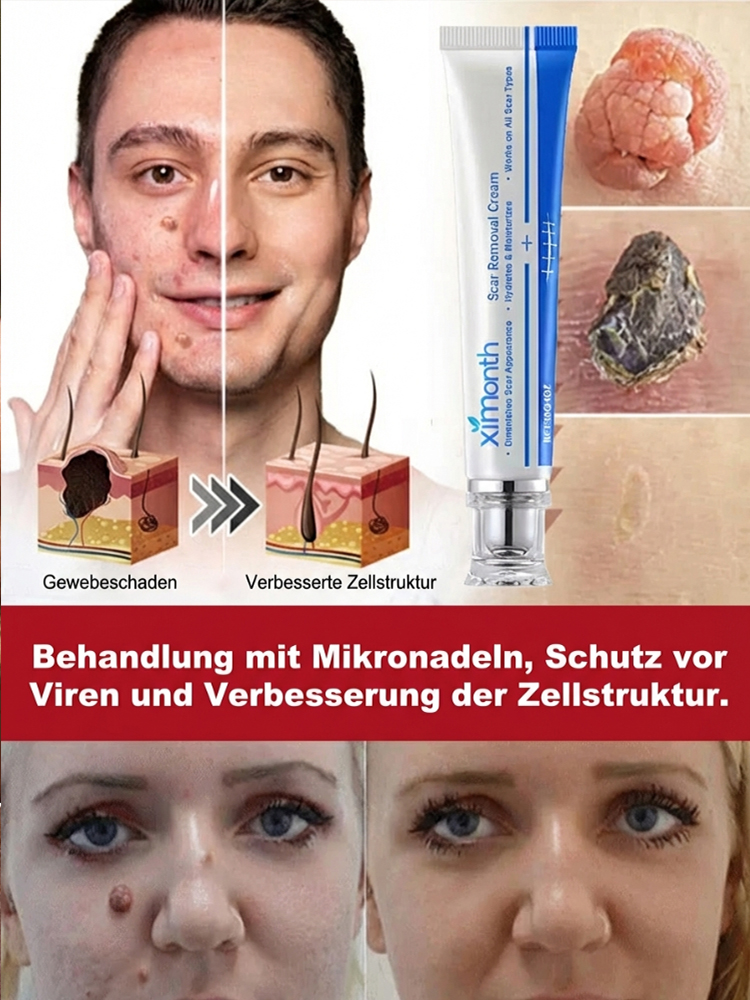 【Ein Wisch entfernt Warzen spurlos】Medizinische schmerzfreie Warzensalbe
