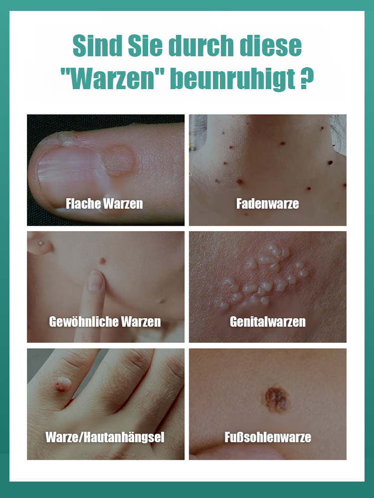 【Dauerhafte Entfernung】 Entfernung von Muttermalen, Warzen und Hautwucherungen, Laser-Muttermalentfe