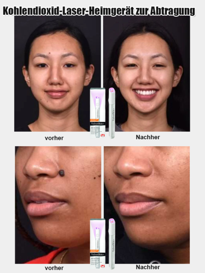 Sanfter Laser-Hautpflegestift zur Entfernung von Muttermalen und Warzen