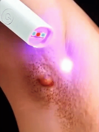 Sanfter Laser-Hautpflegestift zur Entfernung von Muttermalen und Warzen