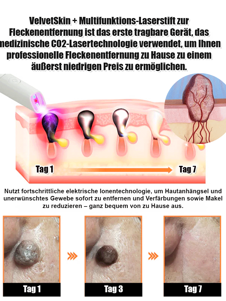 Sanfter Laser-Hautpflegestift zur Entfernung von Muttermalen und Warzen