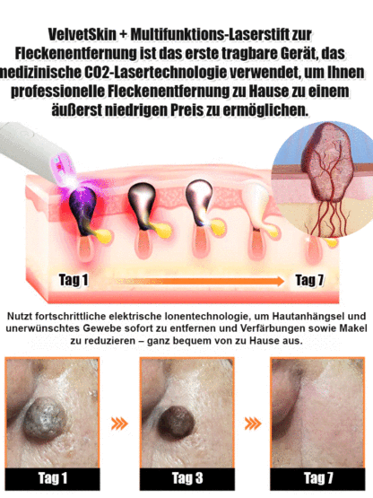 Sanfter Laser-Hautpflegestift zur Entfernung von Muttermalen und Warzen