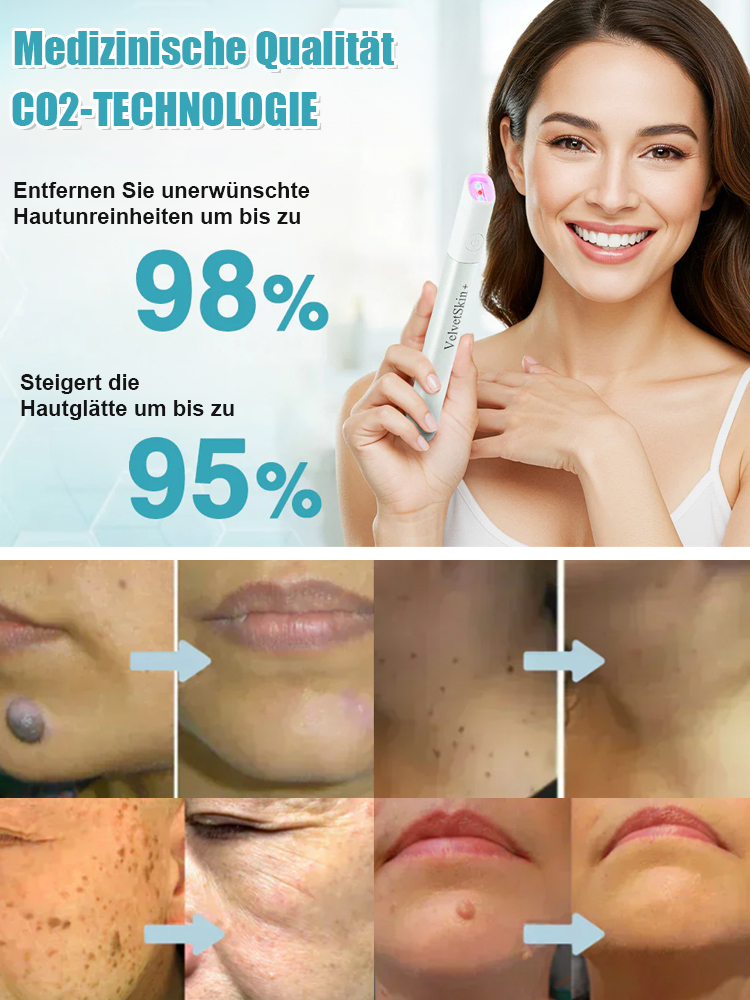 Sanfter Laser-Hautpflegestift zur Entfernung von Muttermalen und Warzen