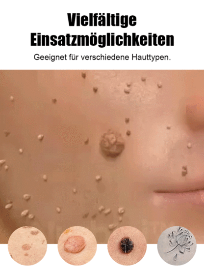 Laser schmerzfreier Warzenentferner-Stift