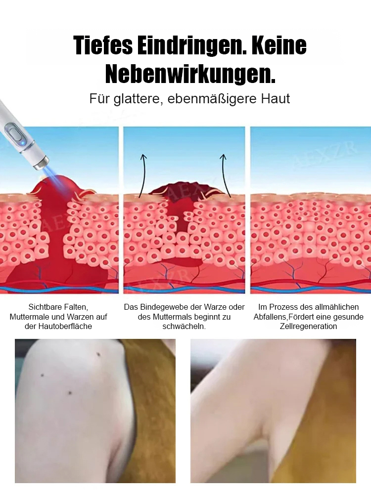 Laser schmerzfreier Warzenentferner-Stift