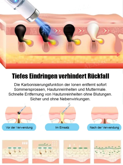 Laser schmerzfreier Warzenentferner-Stift