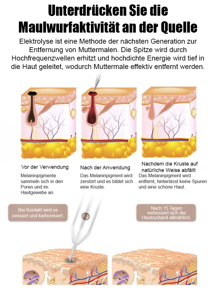 Laser schmerzfreier Warzenentferner-Stift