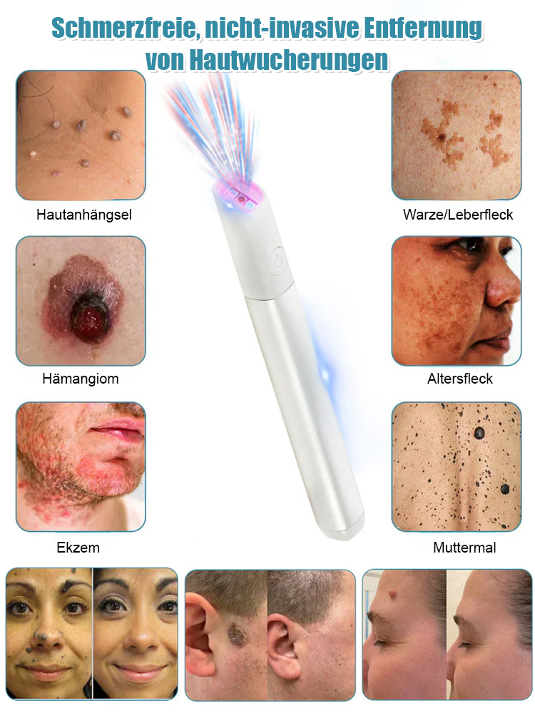 Sanfter Laser-Hautpflegestift zur Entfernung von Muttermalen und Warzen