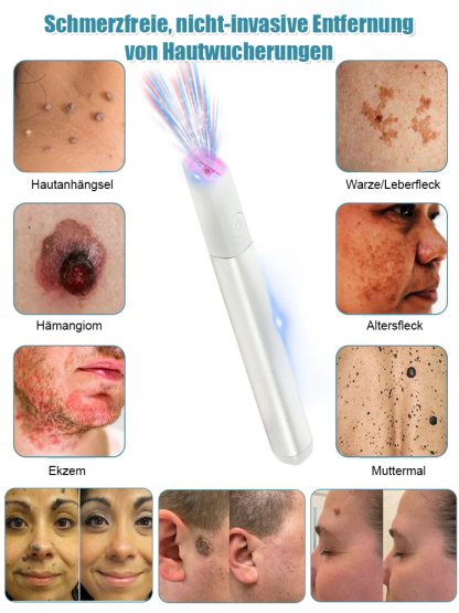 Sanfter Laser-Hautpflegestift zur Entfernung von Muttermalen und Warzen