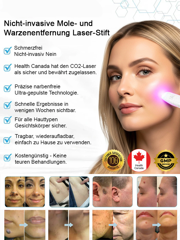 【Dauerhafte Entfernung】 Entfernung von Muttermalen, Warzen und Hautwucherungen, Laser-Muttermalentfe