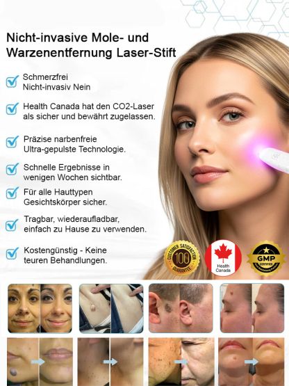【Dauerhafte Entfernung】 Entfernung von Muttermalen, Warzen und Hautwucherungen, Laser-Muttermalentfe