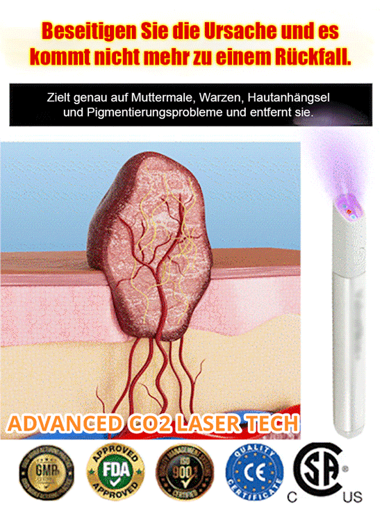【Dauerhafte Entfernung】 Entfernung von Muttermalen, Warzen und Hautwucherungen, Laser-Muttermalentfe