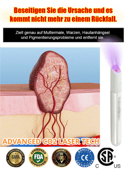 【Dauerhafte Entfernung】 Entfernung von Muttermalen, Warzen und Hautwucherungen, Laser-Muttermalentfe