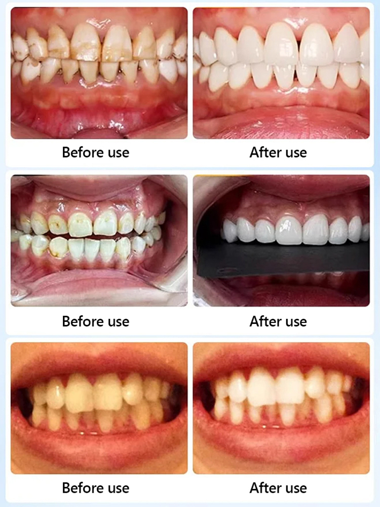 🦷Whiter Teeth Without the Pain! ✨The 10-Minute Glow Up!【At-Home Dental Whitening】Instant Whitening Strips - No peroxide, No gum burn, Just Whit