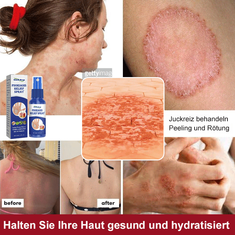 Psoriasis Stop Juckreiz und Schwellung Behandlung Spray