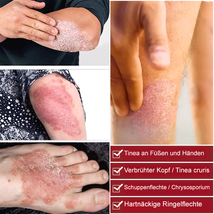 Psoriasis Stop Juckreiz und Schwellung Behandlung Spray