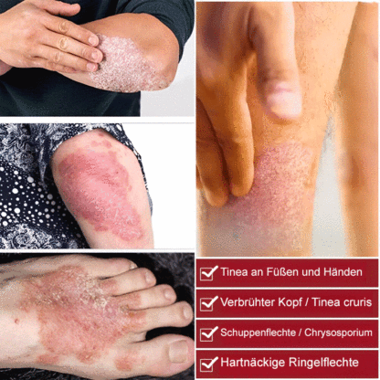 Psoriasis Stop Juckreiz und Schwellung Behandlung Spray