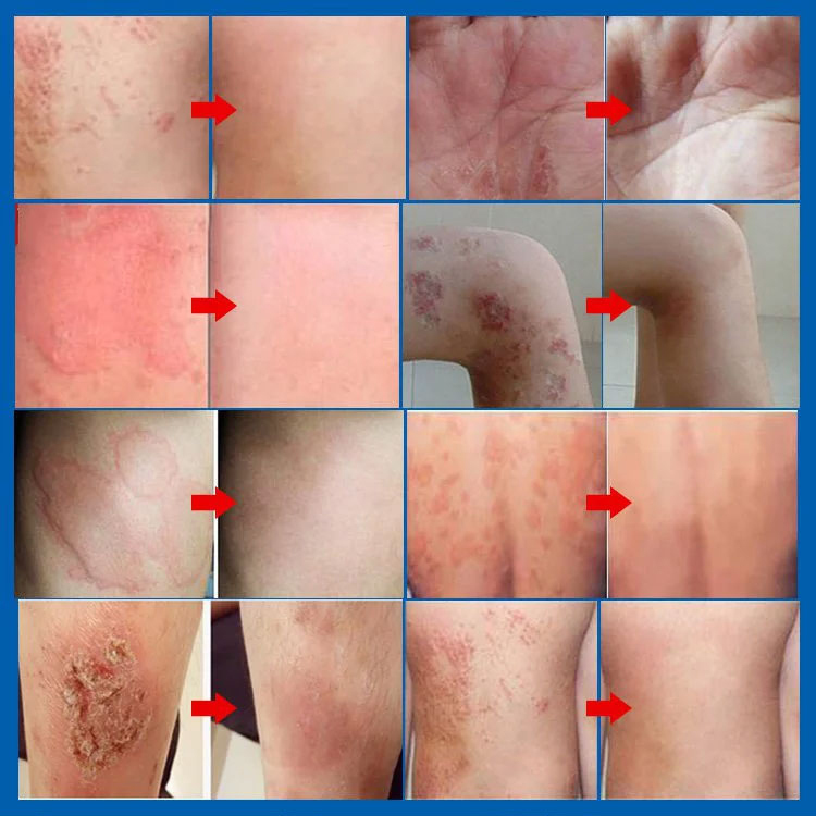 Psoriasis Stop Juckreiz und Schwellung Behandlung Spray