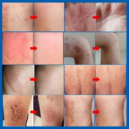 Psoriasis Stop Juckreiz und Schwellung Behandlung Spray