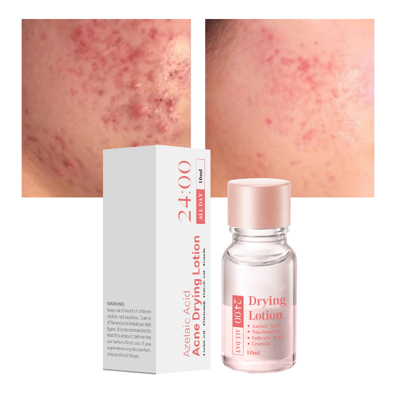 Salicylsyra Spot Treatment – Snabbverkande nattbehandling mot pormaskar & finnar