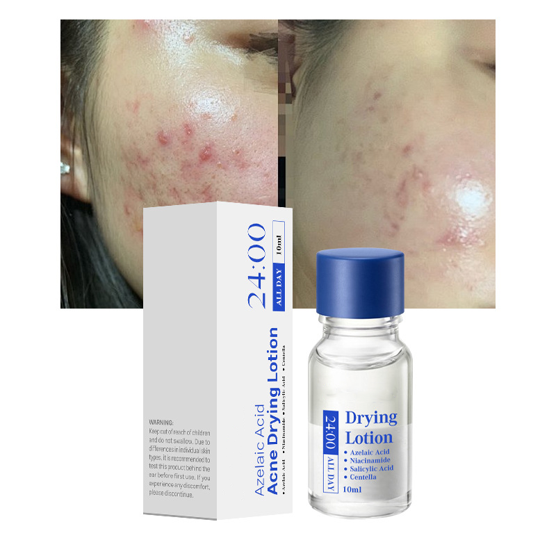 Salicylsyra Spot Treatment – Snabbverkande nattbehandling mot pormaskar & finnar
