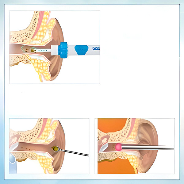 🔥Wireless Electric Ear Cleaner with Vibration & Suction 