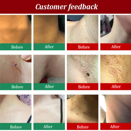 Herbal Powerful Wart Repair Pen