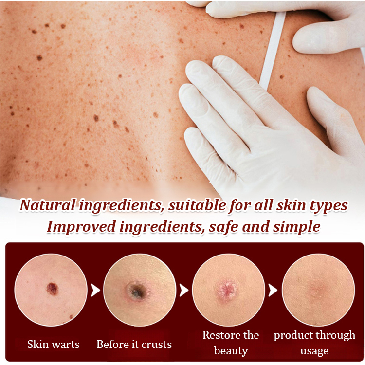 Herbal Powerful Wart Repair Pen