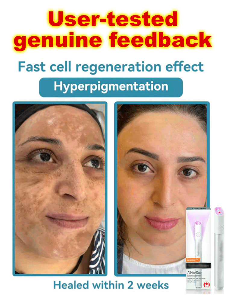 Laser mole removal pen