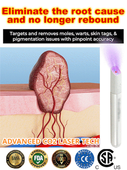 Laser mole removal pen