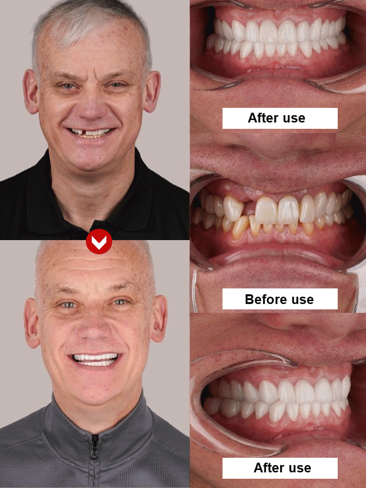 Strong Suction Full Denture for Confident Smile