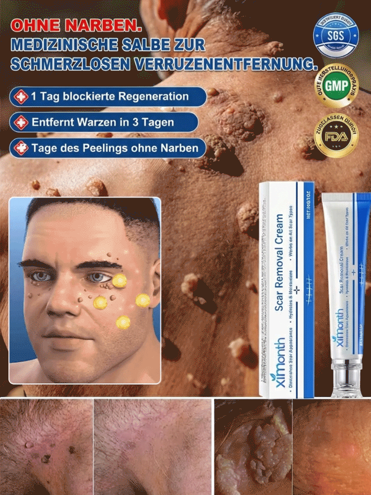 【Ein Wisch entfernt Warzen spurlos】Von Hautärzten empfohlen – Warzencreme 🩺